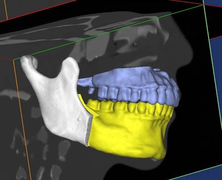 CT aufnahme eines Gebisses mit blau markiertem oberkiefer und gelb markiertem unterkiefer