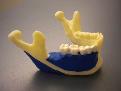 Modell von einem Unterkieferimplantat