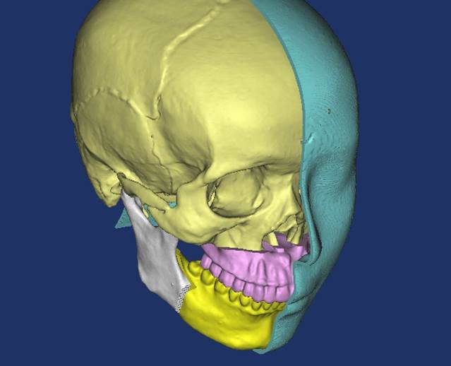 3D visualisierung eines Schädels zur Simulation von Weichteilgewebeveränderungen nach Chirurgie 