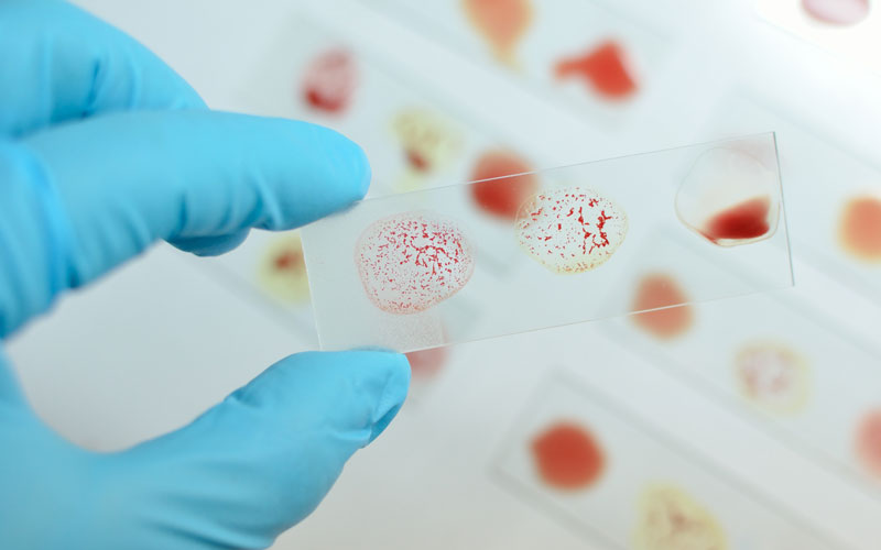 © Jarun Ontakrai/Shutterstock.com Objektträger mit Blutproben