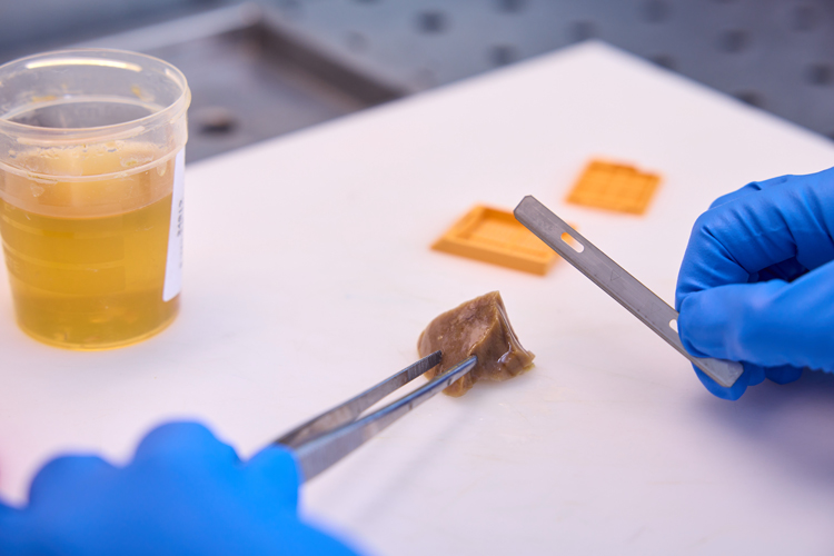 Nahaufnahme der Probenvorbereitung in einem medizinischen Labor. Die Gewebeprobe wird mit einer Pinzette fixiert und mit einer Skalpellklinge bearbeitet. Im Hintergrund sieht man orangefarbene Einbettkassetten für die Histologie sowie einen transparenten Kunststoffbecher mit einer gelblichen Fixierungsflüssigkeit.